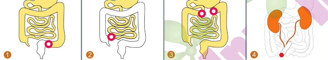 ViStoma® 造口护理系列