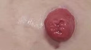 造口周围皮肤红肿、破溃,究竟是何原因? 造口周围皮肤红肿、破溃,究竟是何原因?