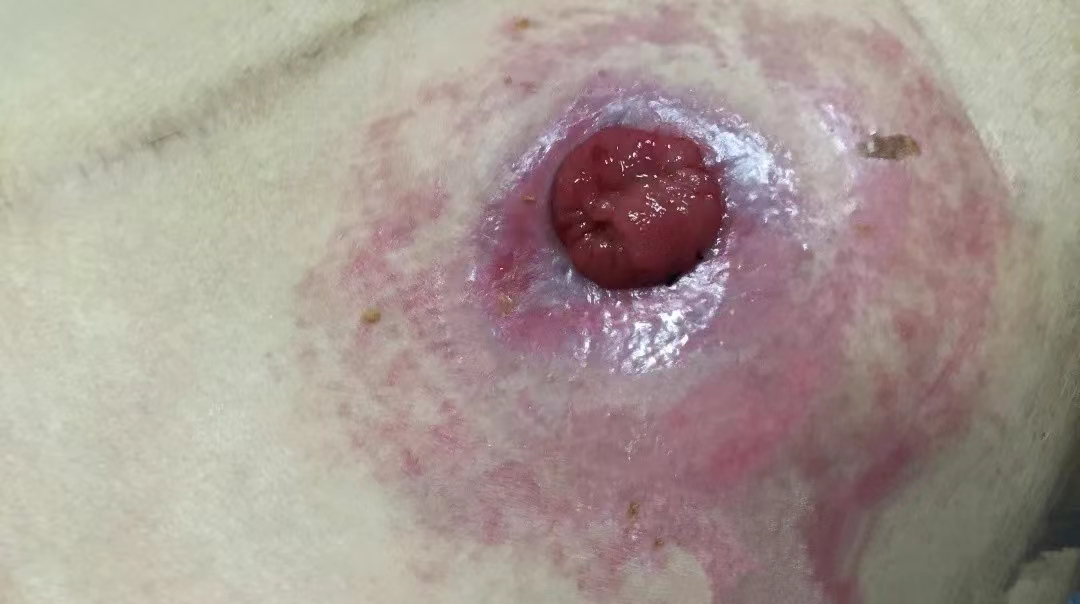 造口周围皮肤红肿、破溃,究竟是何原因? 造口周围皮肤红肿、破溃,究竟是何原因?